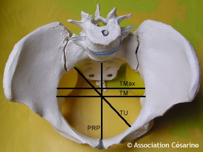 Bassin et Pelvimtrie - Figure 10 © Association Csarine